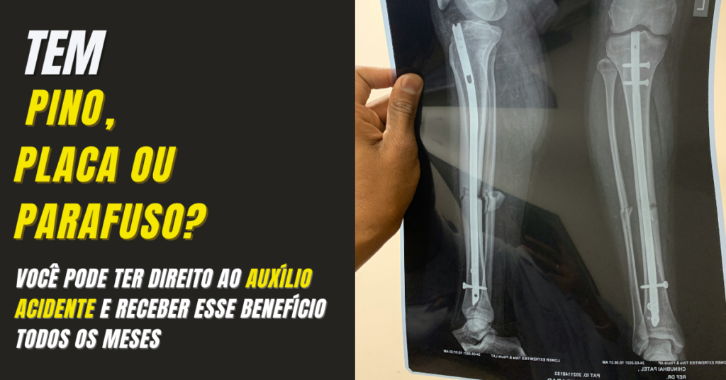 auxílio acidente